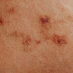 Detailed view of skin with red spots and discoloration, common in dermatology studies.